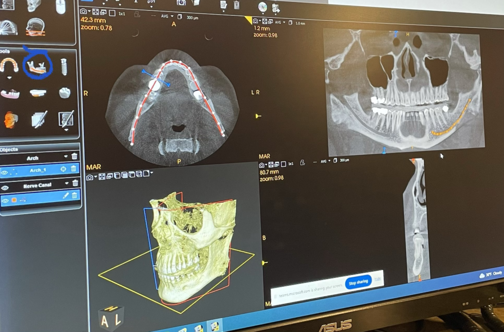 CBCT software displaying dental image planes and a three-dimensional reconstruction