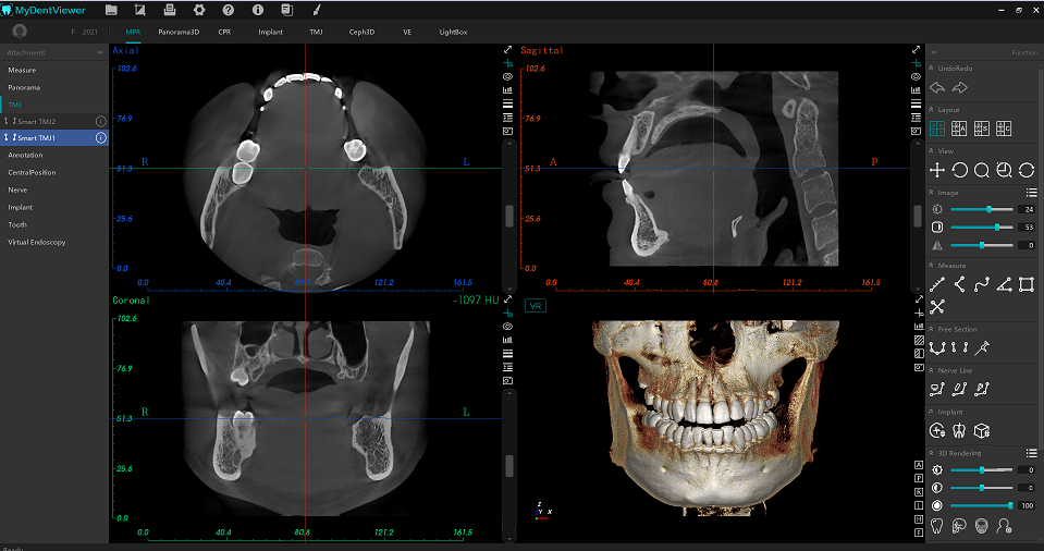 Axial, sagittal and coronal CBCT views alongside a three-dimensional reconstruction